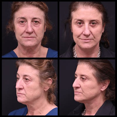 Face/Neck Lift Before & After Gallery - Patient 348866 - Image 1