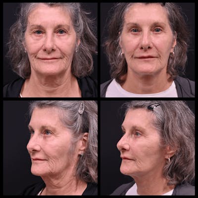 Face/Neck Lift Before & After Gallery - Patient 322014 - Image 1