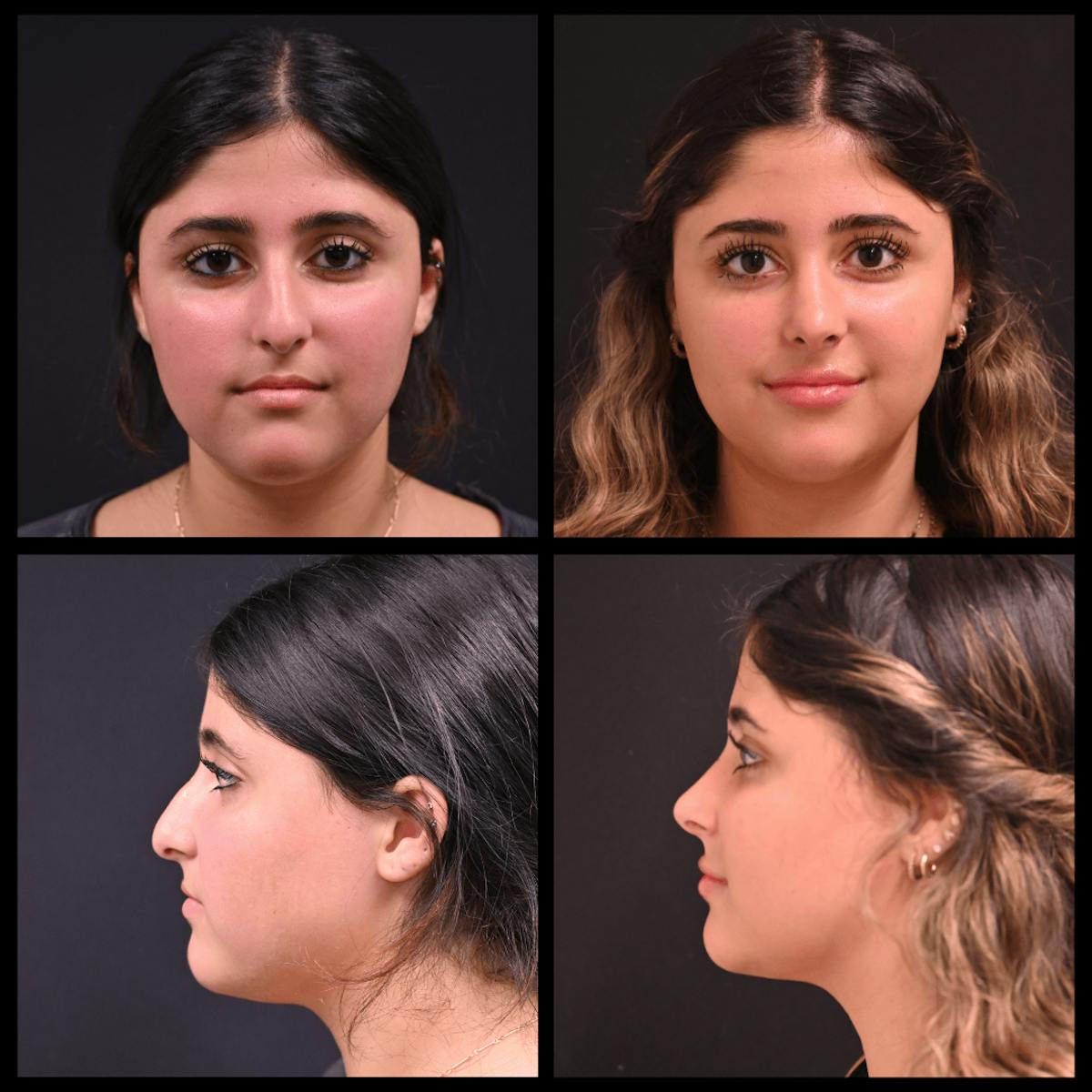 Rhinoplasty (Nose Job) Before & After Gallery - Patient 319773 - Image 1