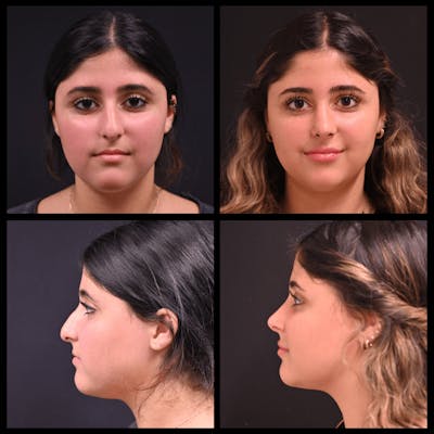 BodyTite and FaceTite Before & After Gallery - Patient 136757 - Image 1