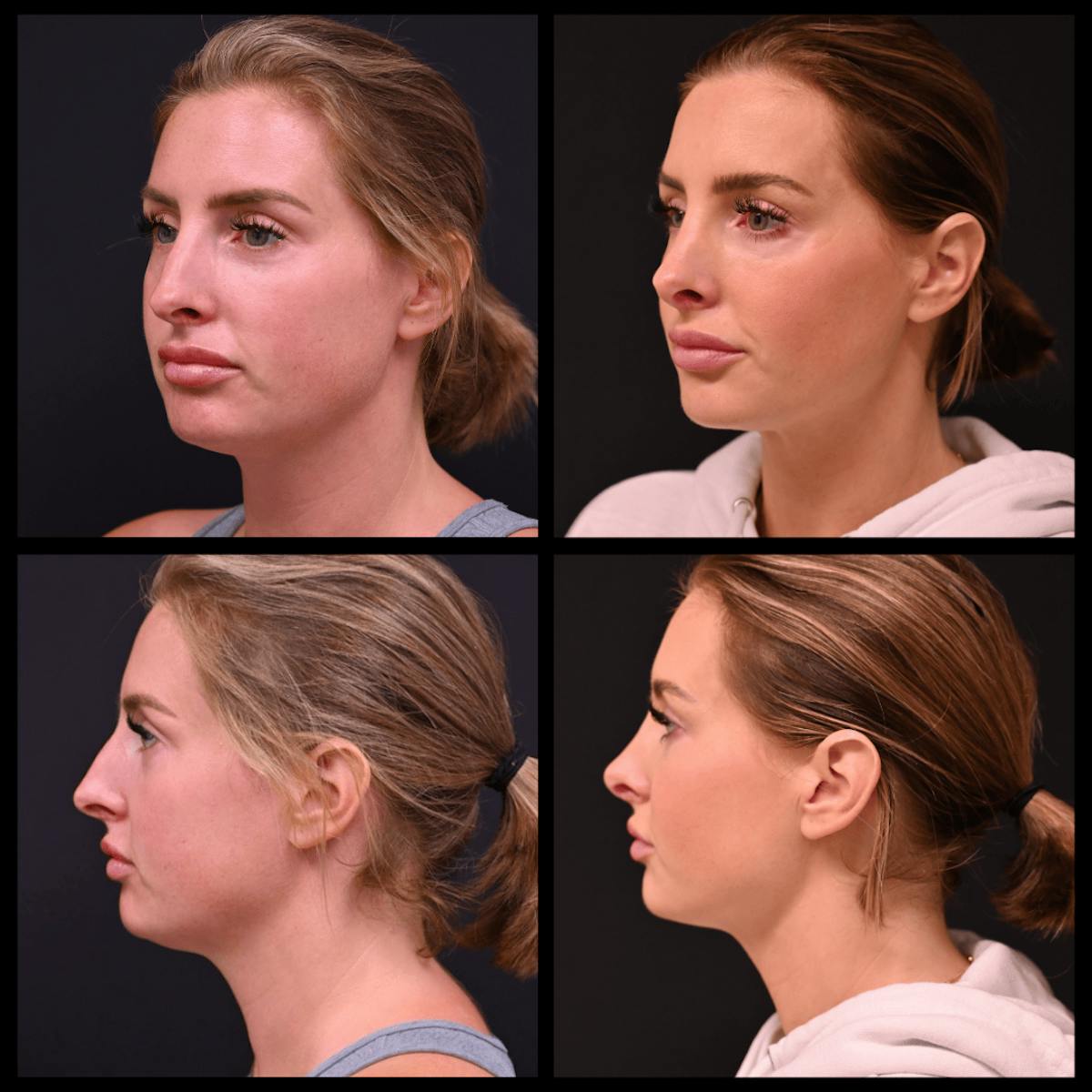 BodyTite and FaceTite Before & After Gallery - Patient 187268 - Image 1