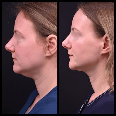 BodyTite and FaceTite Before & After Gallery - Patient 721769 - Image 1