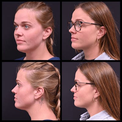 BodyTite and FaceTite Before & After Gallery - Patient 116525 - Image 1