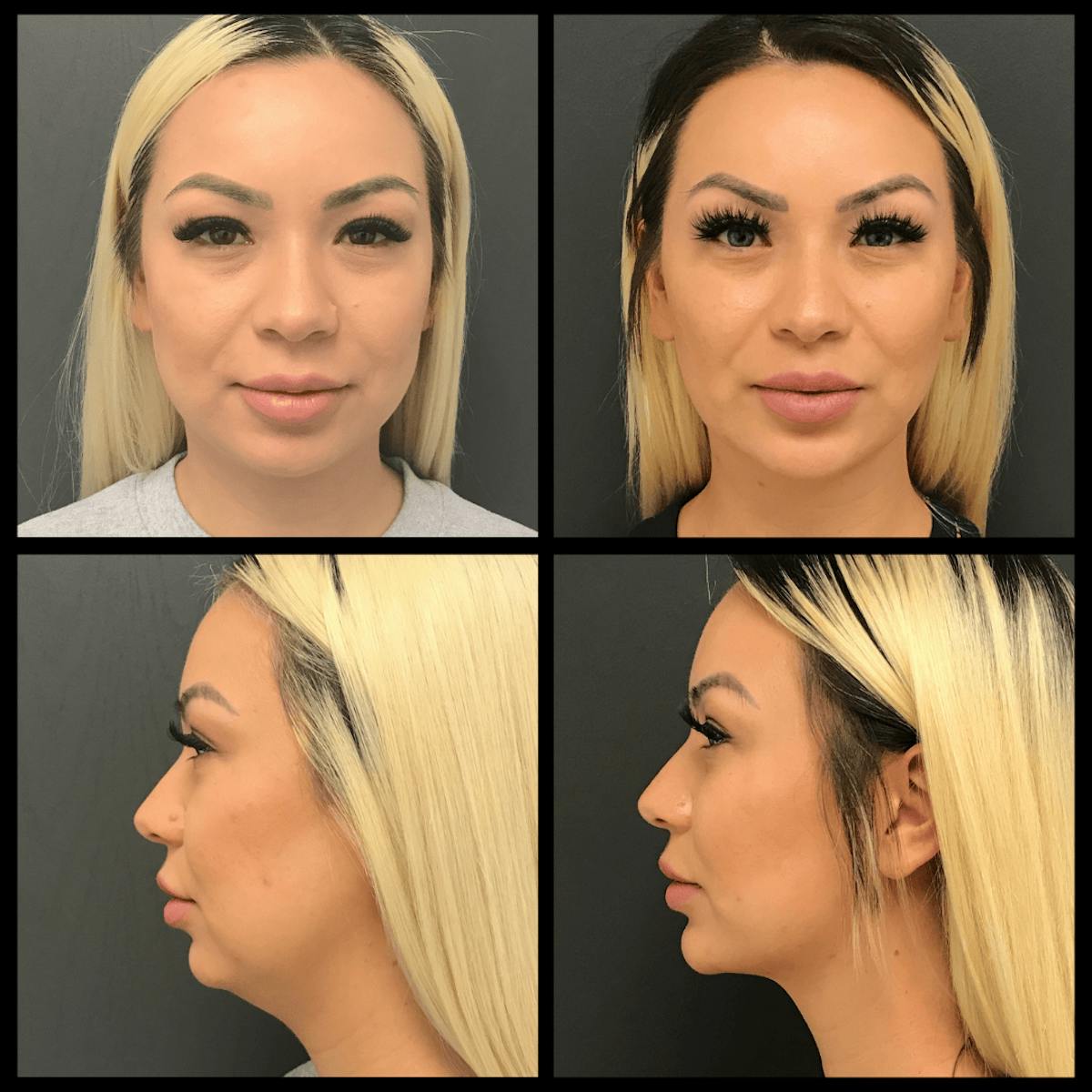 BodyTite and FaceTite Before & After Gallery - Patient 676823 - Image 1