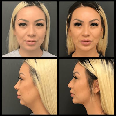 BodyTite and FaceTite Before & After Gallery - Patient 676823 - Image 1