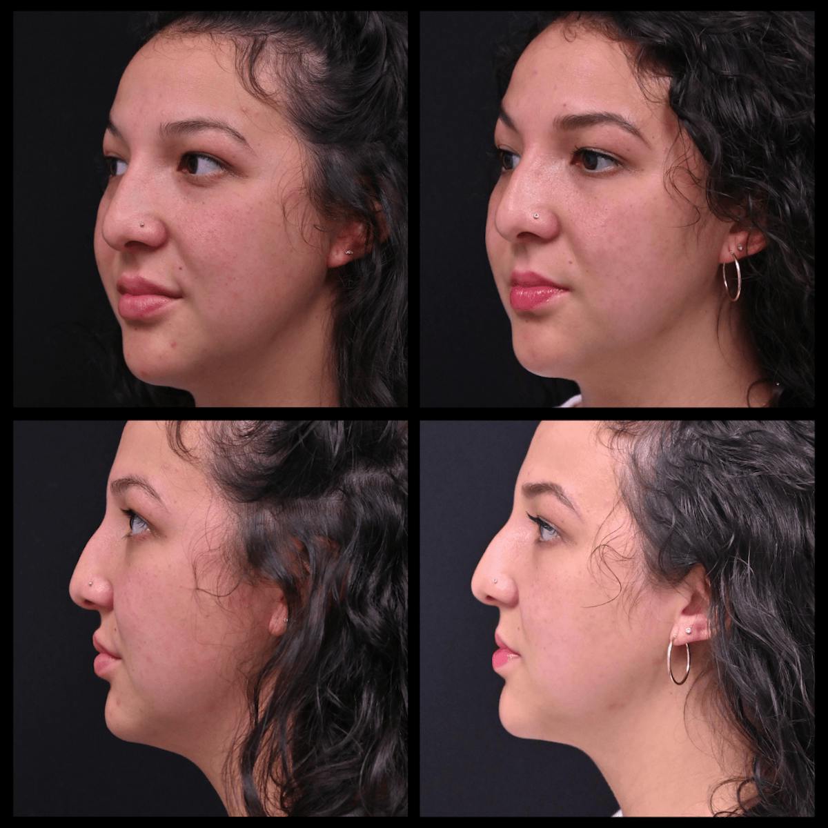 BodyTite and FaceTite Before & After Gallery - Patient 387286 - Image 1