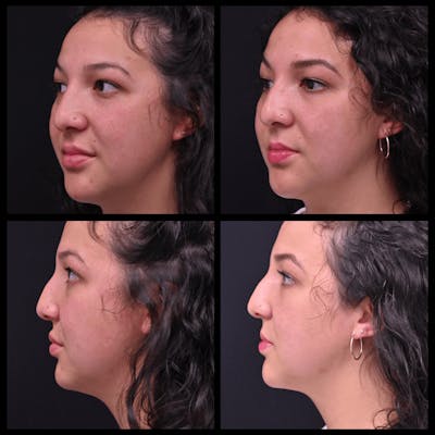 BodyTite and FaceTite Before & After Gallery - Patient 387286 - Image 1
