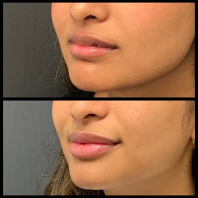 Lip Filler Before & After Gallery - Patient 211912 - Image 1