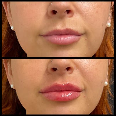 Lip Filler Before & After Gallery - Patient 841755 - Image 1