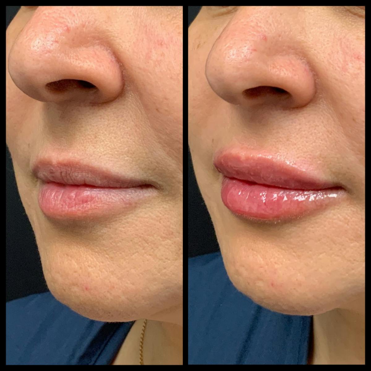 Lip Filler Before & After Gallery - Patient 371684 - Image 1