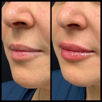 Lip Filler Before & After Gallery - Patient 371684 - Image 1
