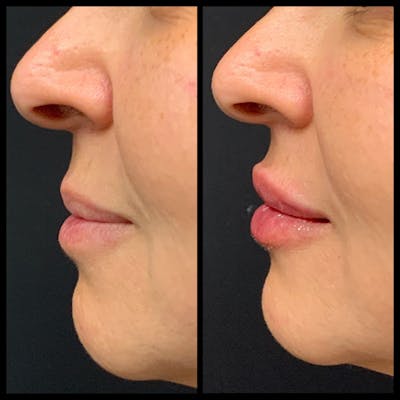 Lip Filler Before & After Gallery - Patient 292498 - Image 1
