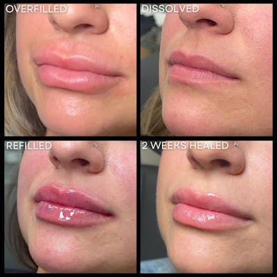 Lip Filler Before & After Gallery - Patient 345507 - Image 1