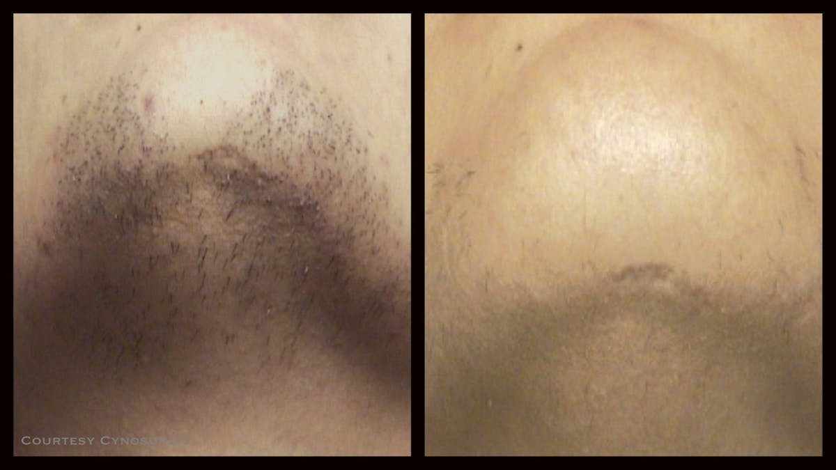 Laser Hair/Vein Removal Before & After Gallery - Patient 188924 - Image 1