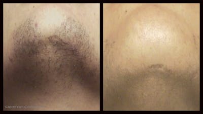 Laser Hair/Vein Removal Before & After Gallery - Patient 188924 - Image 1