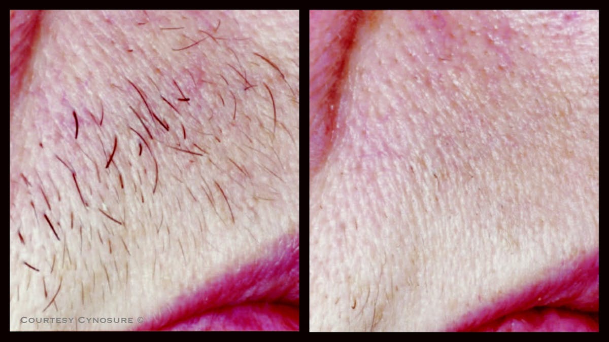 Laser Hair/Vein Removal Before & After Gallery - Patient 149071 - Image 1