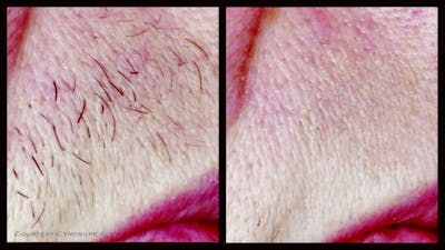 Laser Hair/Vein Removal Before & After Gallery - Patient 149071 - Image 1