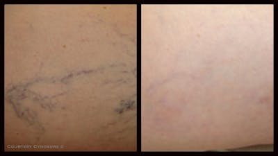 Laser Hair/Vein Removal Before & After Gallery - Patient 234553 - Image 1