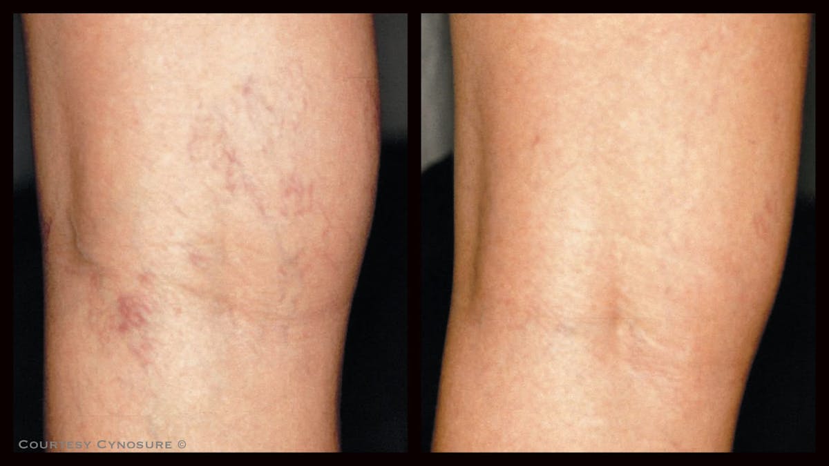 Laser Hair/Vein Removal Before & After Gallery - Patient 155069 - Image 1