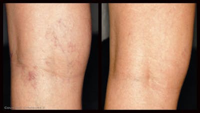 Laser Hair/Vein Removal Before & After Gallery - Patient 155069 - Image 1