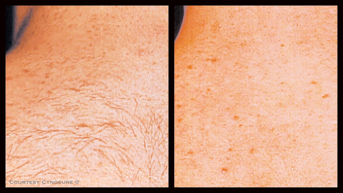 Laser Hair/Vein Removal Before & After Gallery - Patient 407931 - Image 1