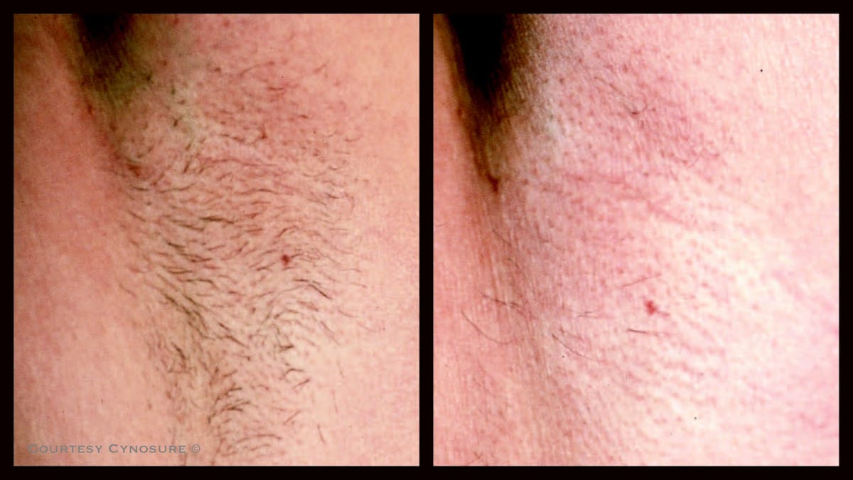 Laser Hair/Vein Removal Before & After Gallery - Patient 341620 - Image 1