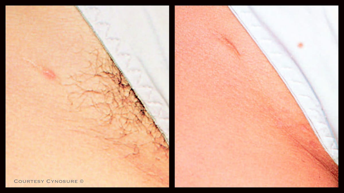 Laser Hair/Vein Removal Before & After Gallery - Patient 166013 - Image 1