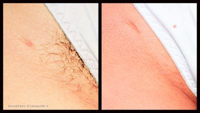 Laser Hair/Vein Removal Before & After Gallery - Patient 166013 - Image 1