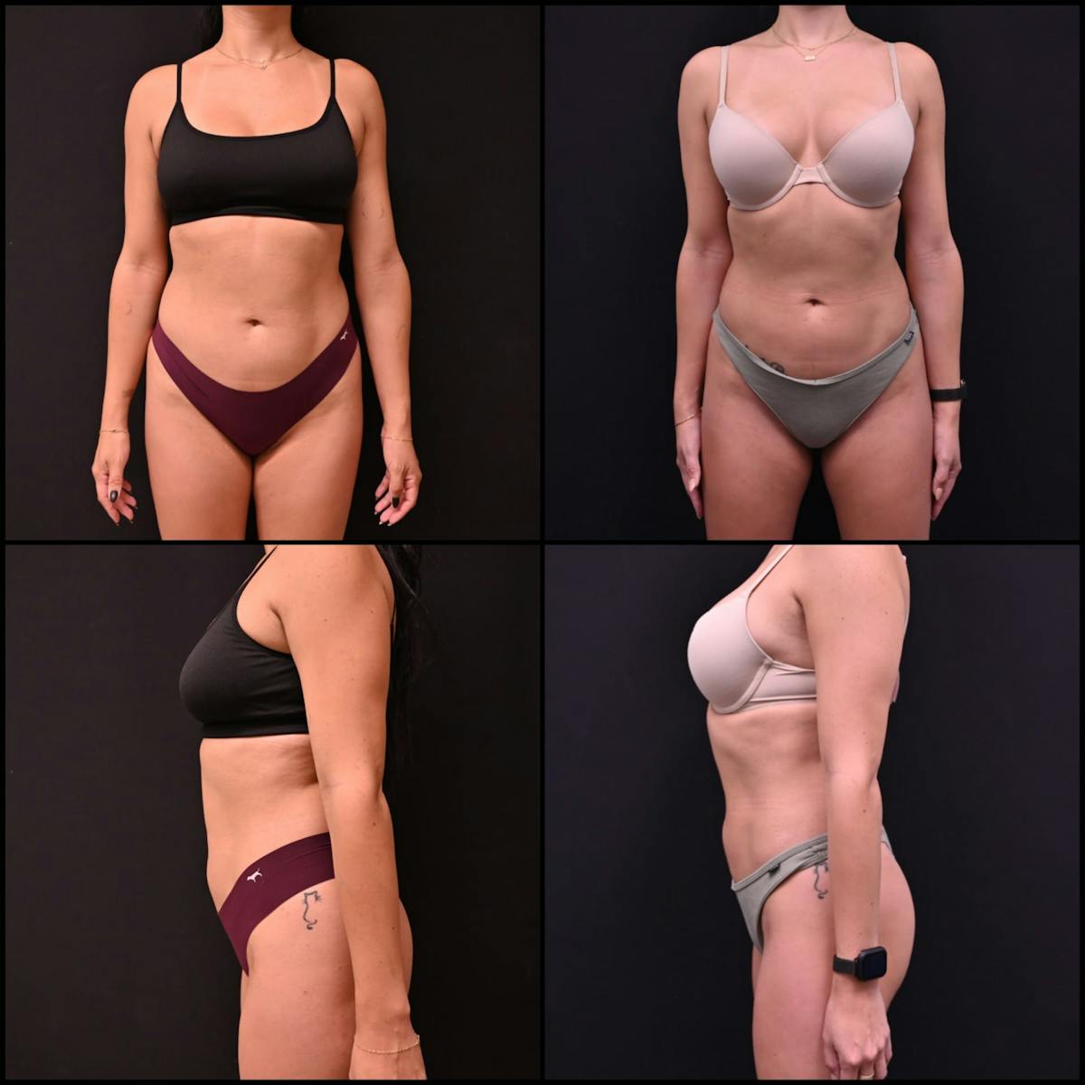 Liposuction Before & After Gallery - Patient 483711 - Image 1