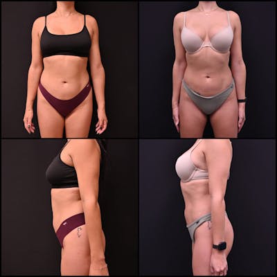 Liposuction Before & After Gallery - Patient 483711 - Image 1