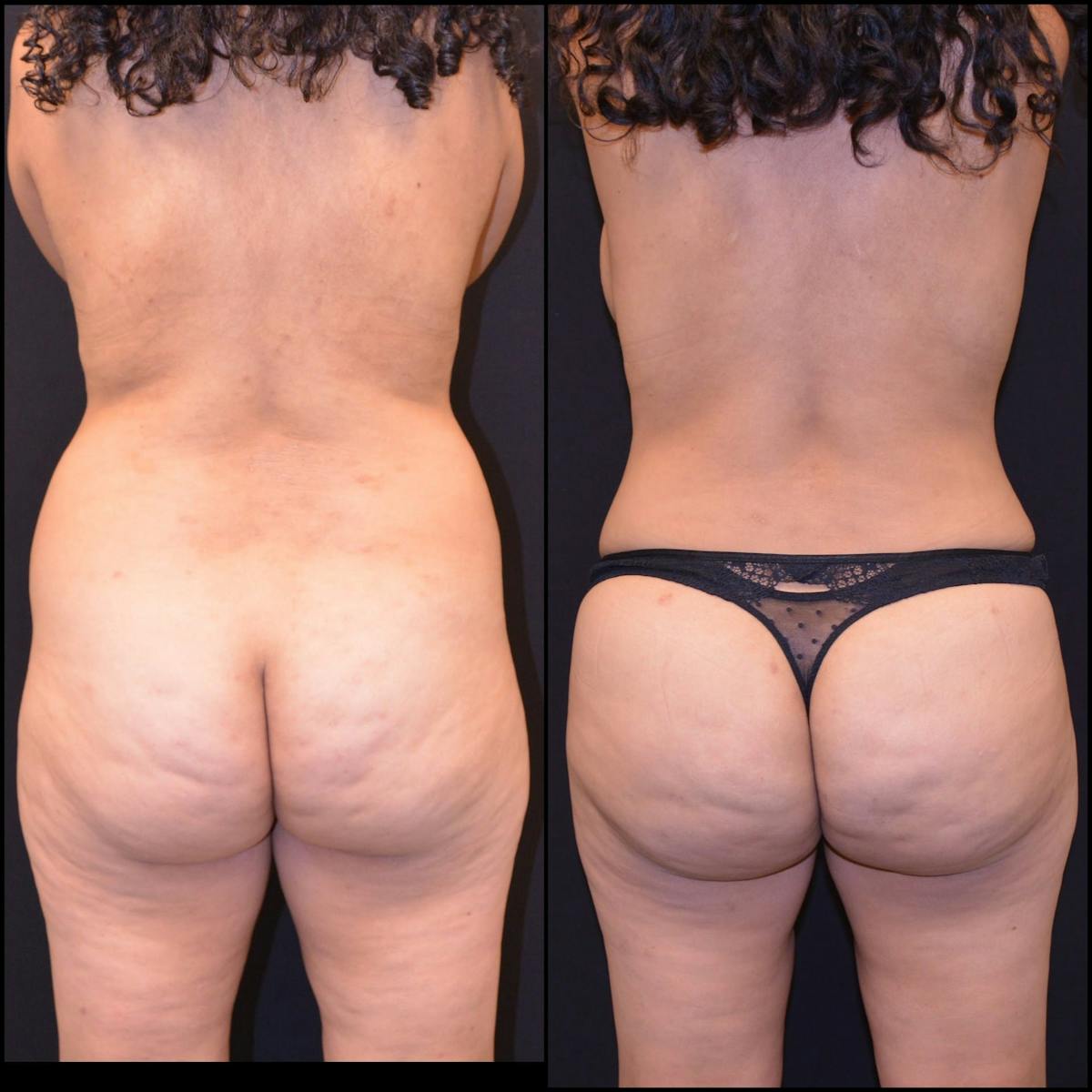 Liposuction Before & After Gallery - Patient 356960 - Image 1