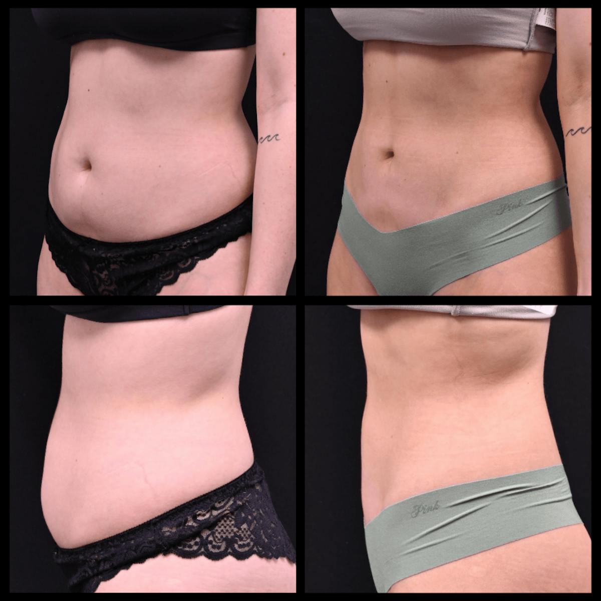 Liposuction Before & After Gallery - Patient 406991 - Image 1