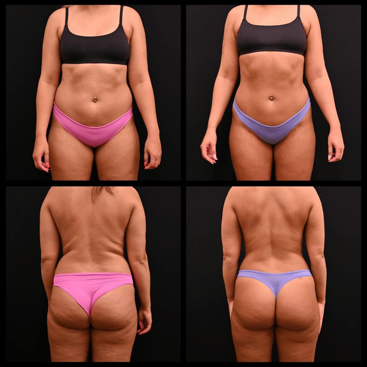 Liposuction Before & After Gallery - Patient 451283 - Image 1