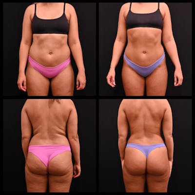 Liposuction Before & After Gallery - Patient 451283 - Image 1
