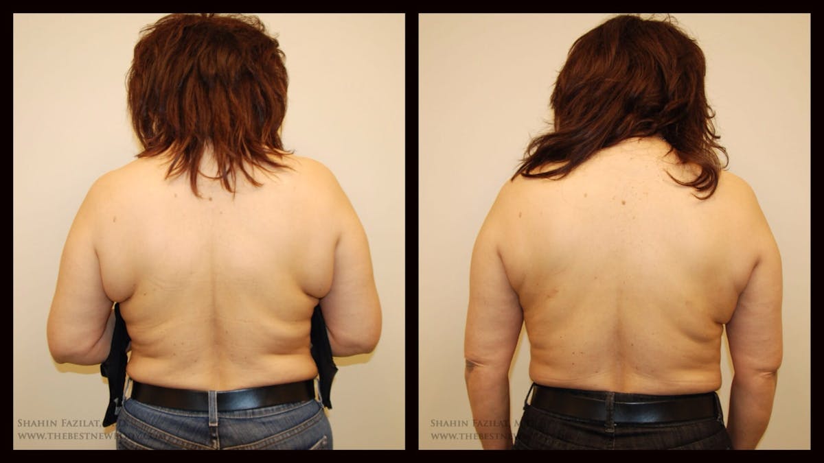 Liposuction Before & After Gallery - Patient 131684 - Image 1