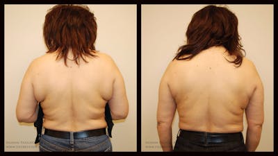 Liposuction Before & After Gallery - Patient 131684 - Image 1