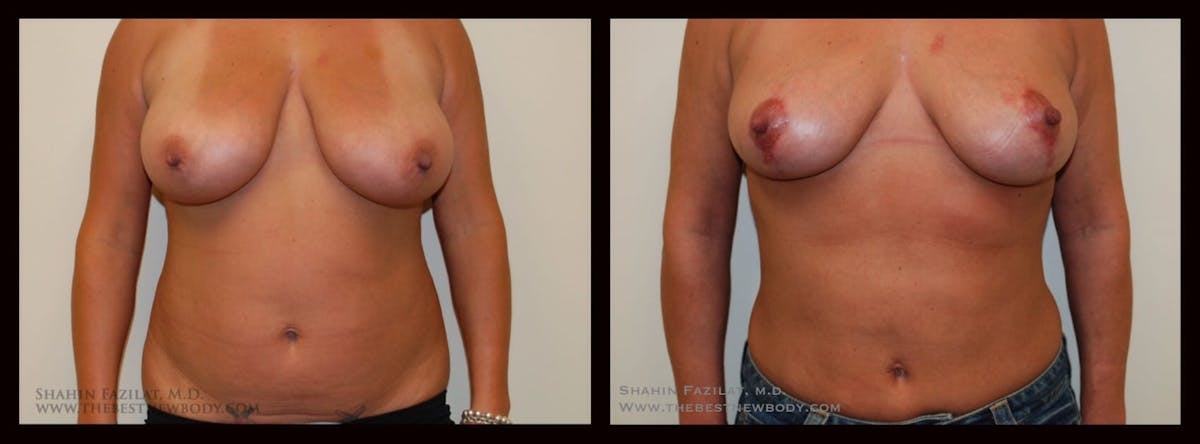 Liposuction Before & After Gallery - Patient 104171 - Image 1