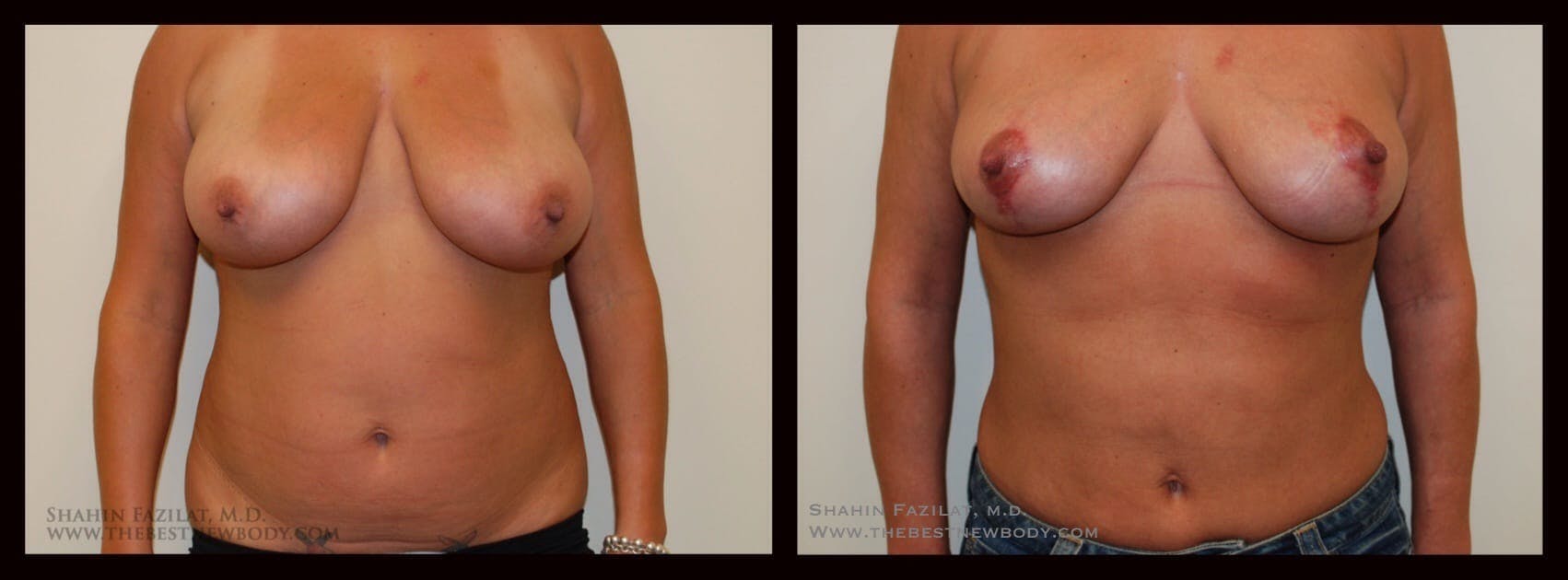 Liposuction Before & After Gallery - Patient 104171 - Image 1