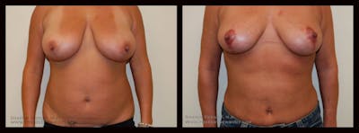 Liposuction Before & After Gallery - Patient 104171 - Image 1