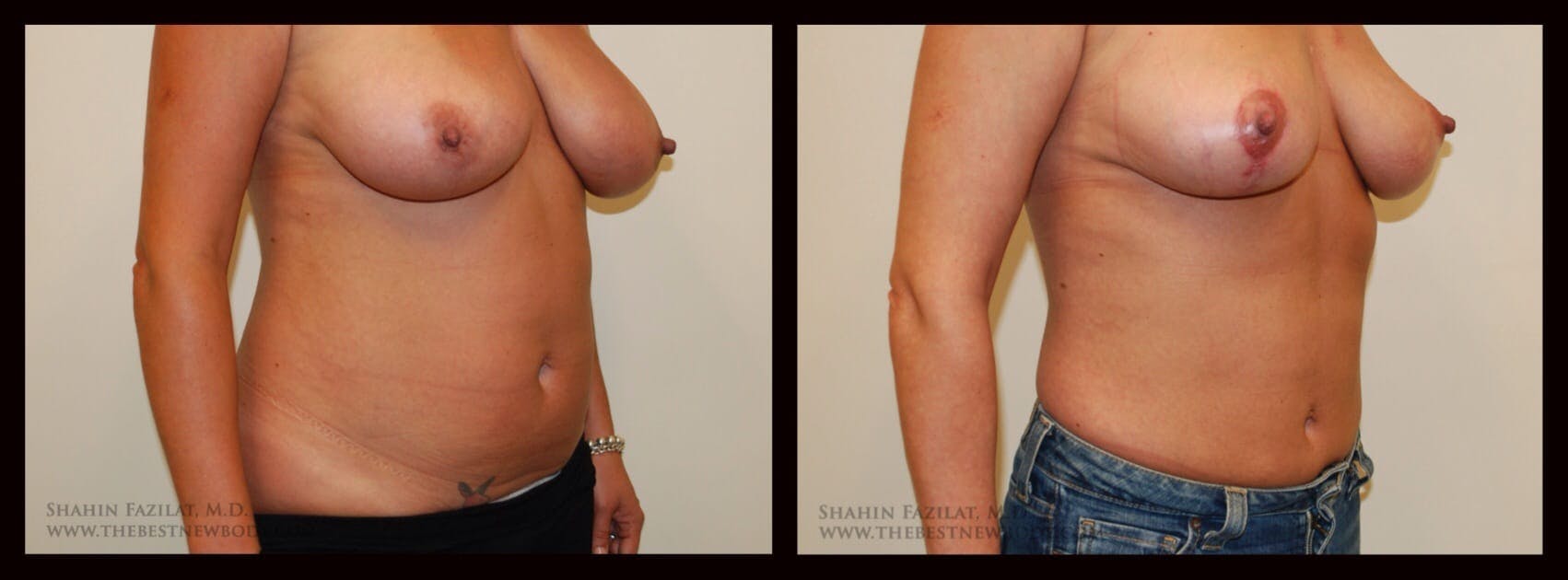 Liposuction Before & After Gallery - Patient 104171 - Image 2