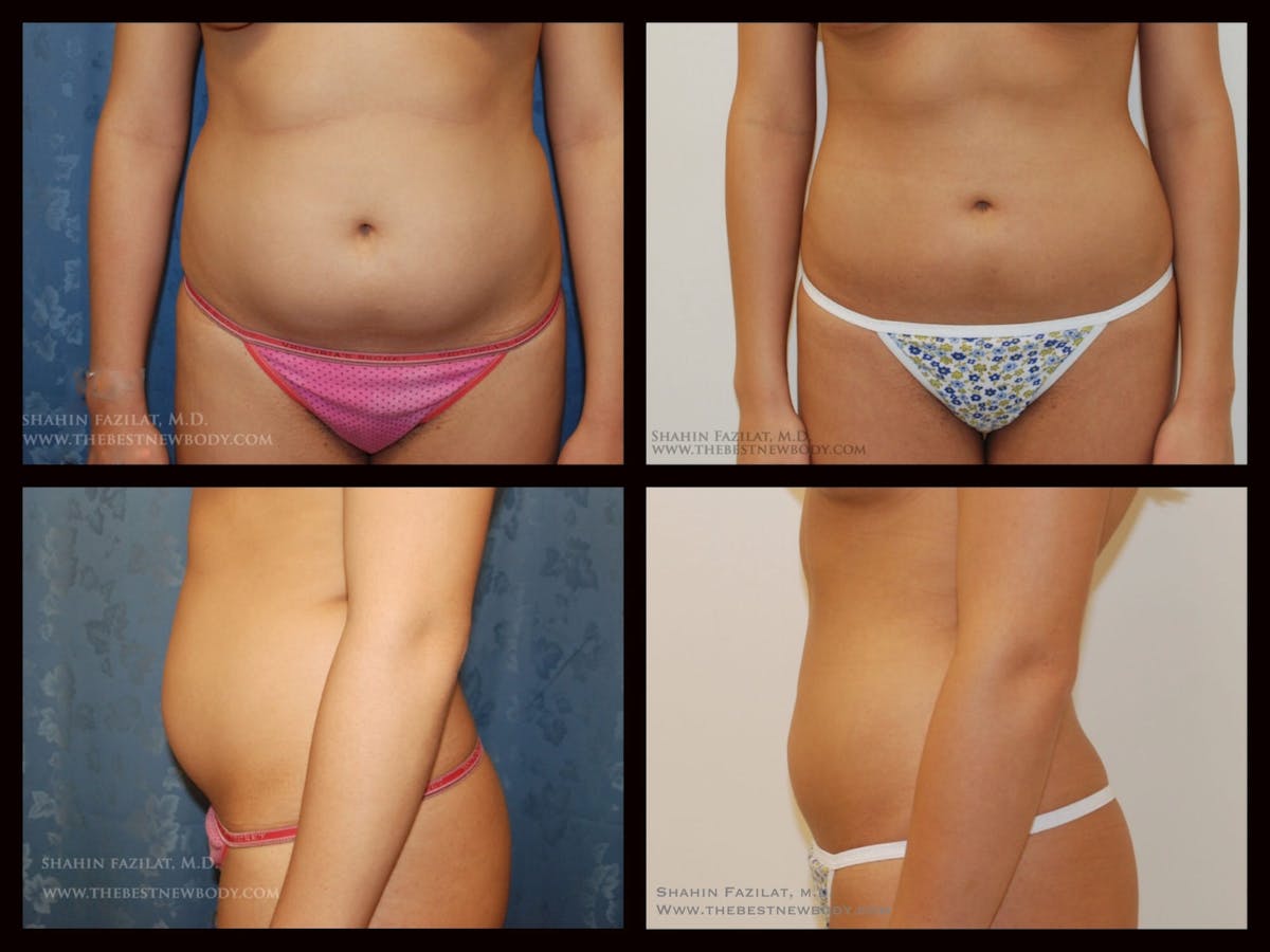 Liposuction Before & After Gallery - Patient 262372 - Image 1