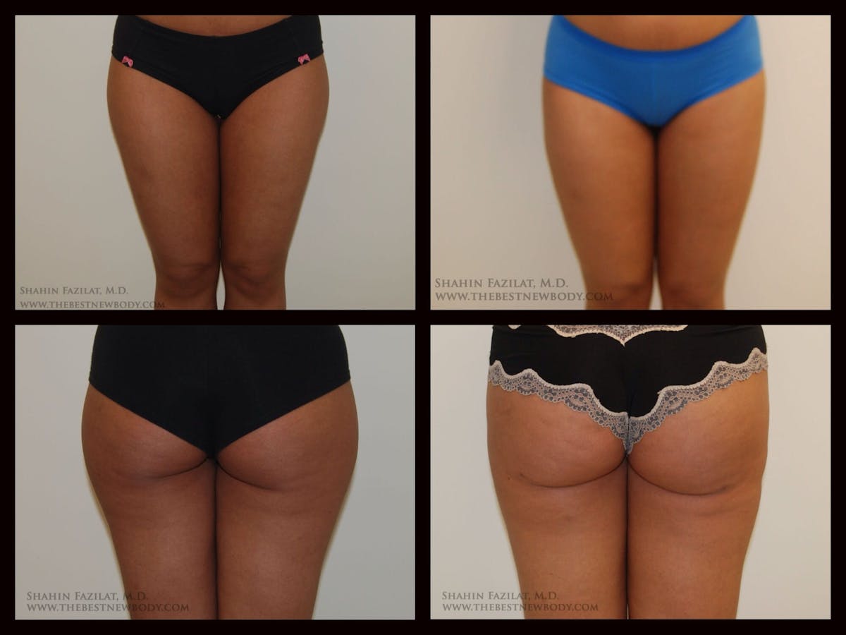 Liposuction Before & After Gallery - Patient 305431 - Image 1