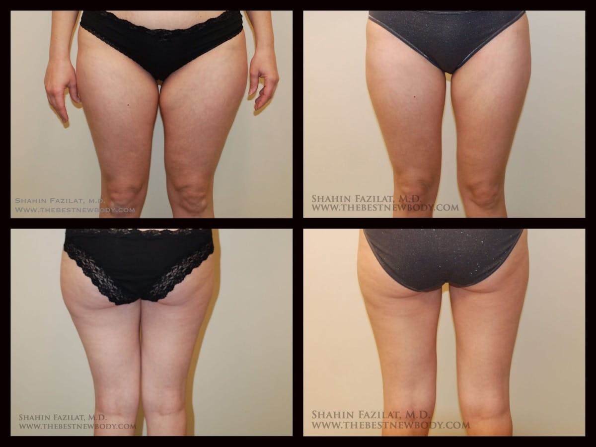 Liposuction Before & After Gallery - Patient 947676 - Image 1