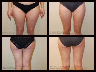 Liposuction Before & After Gallery - Patient 947676 - Image 1
