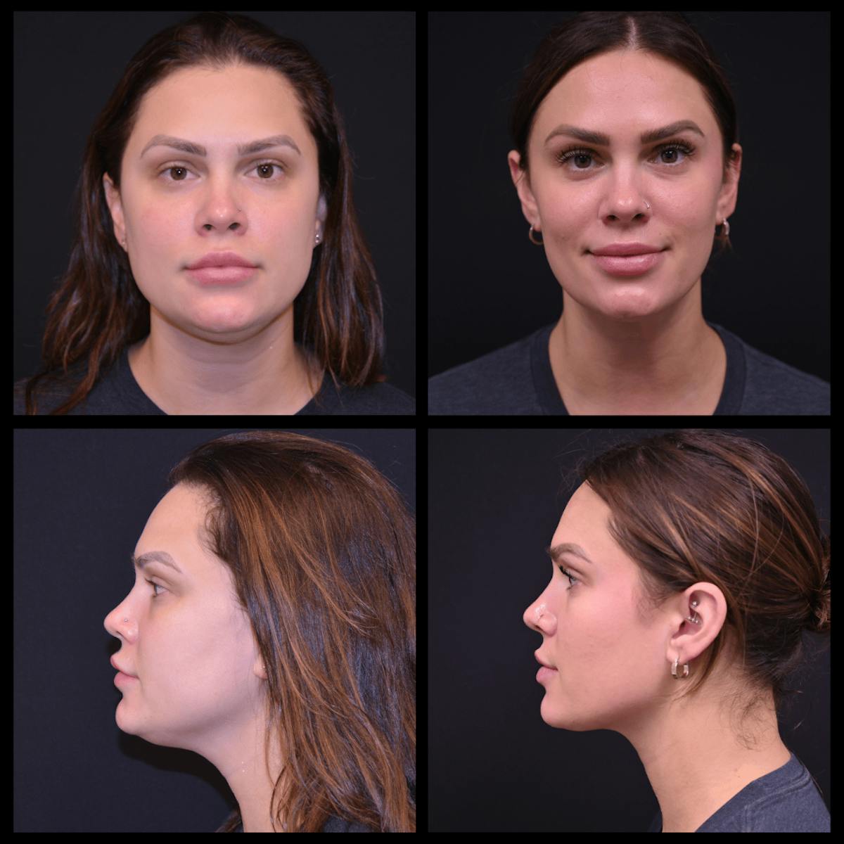 Liposuction Before & After Gallery - Patient 375461 - Image 1