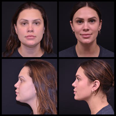 Liposuction Before & After Gallery - Patient 375461 - Image 1