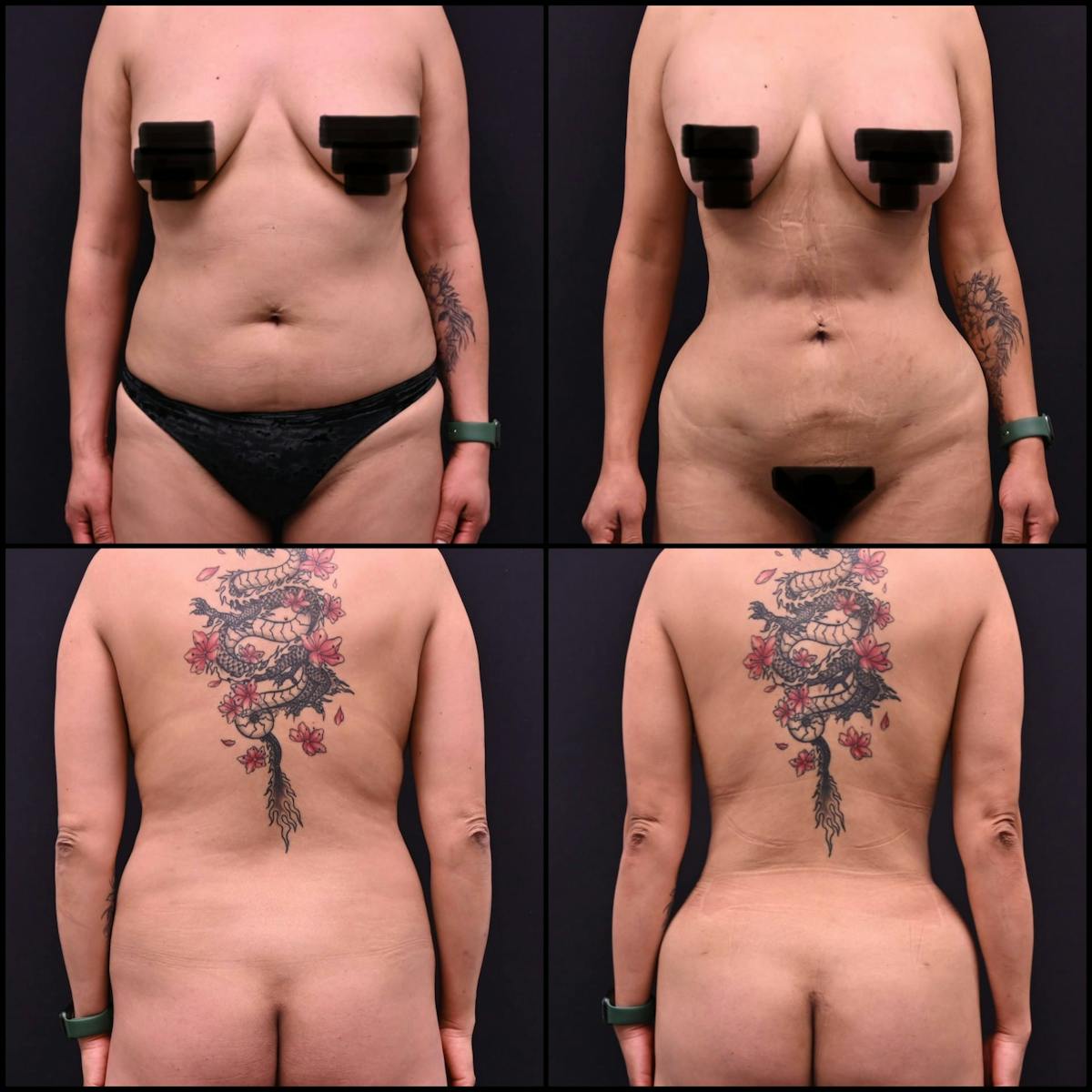 Liposuction Before & After Gallery - Patient 164384 - Image 1