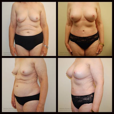 Mommy Makeover Before & After Gallery - Patient 224469 - Image 1