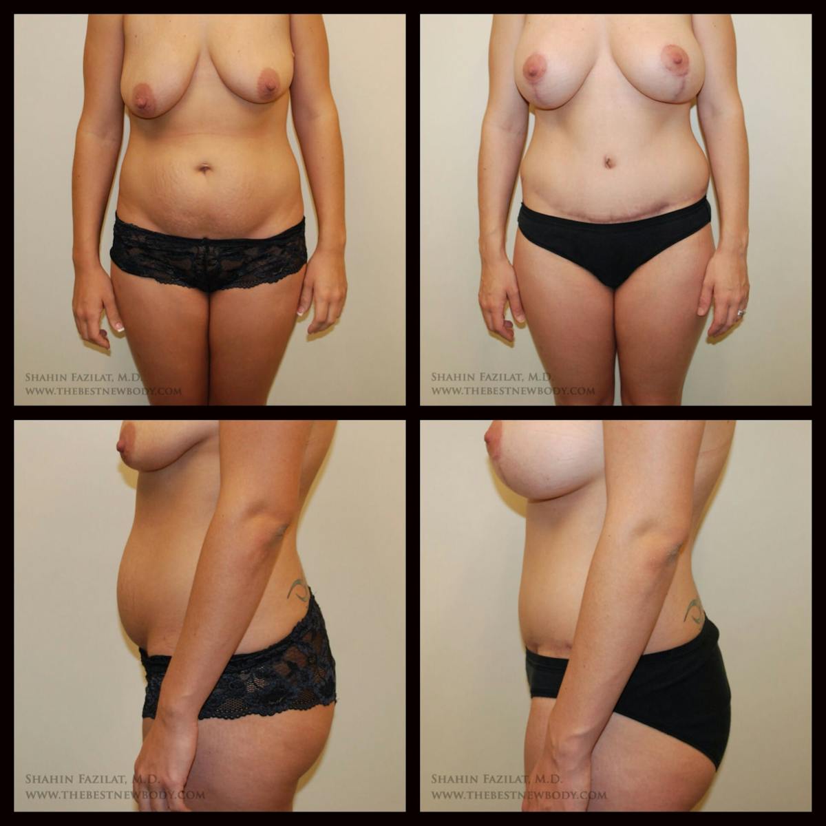 Mommy Makeover Before & After Gallery - Patient 278370 - Image 1