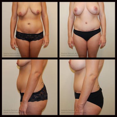 Mommy Makeover Before & After Gallery - Patient 278370 - Image 1